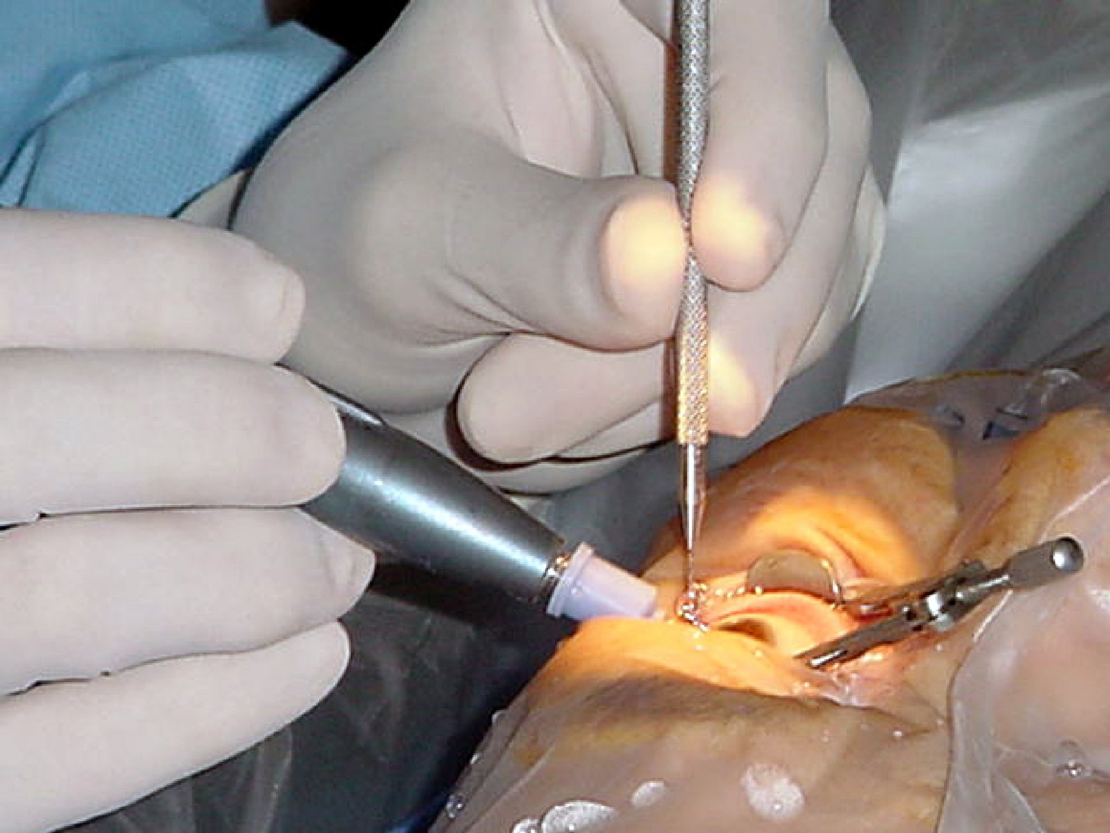 Cataract Surgery